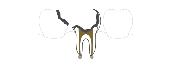 C4（歯根の虫歯）