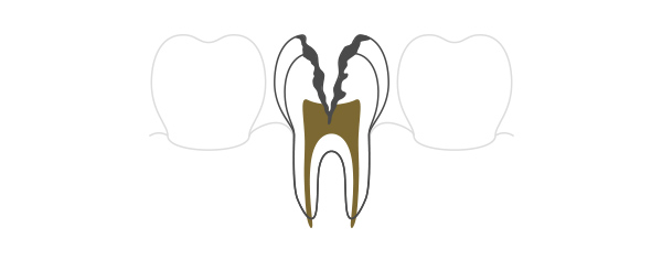 C3（神経の虫歯）